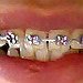 BucketList + Get Braces And Straighten My ... = ✓