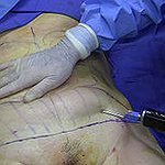 BucketList + Get Liposuction = ✓