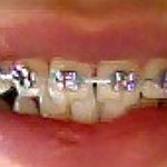 BucketList + Get Braces And Straighten My ... = ✓
