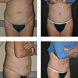 BucketList + Get A Tummy Tuck