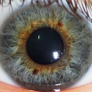 BucketList + Get Corrective Eye Surgery