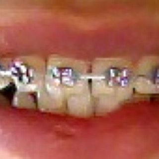 BucketList + Get Braces And Straighten My Teeth